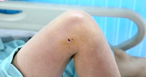 Bị gà trống tấn công, người phụ nữ phải nhập viện cấp cứu - Ảnh 1. Vết mổ của gà trống khiến bệnh nhân sốt cao, phải nhập viện cấp cứu. Ảnh: BVCC