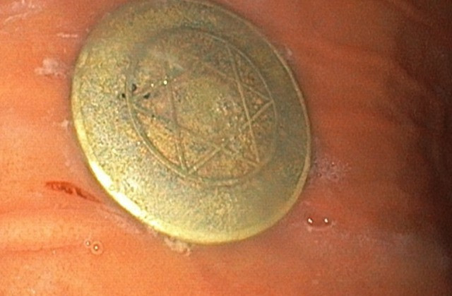 Đồng xu trong dạ dày trẻ