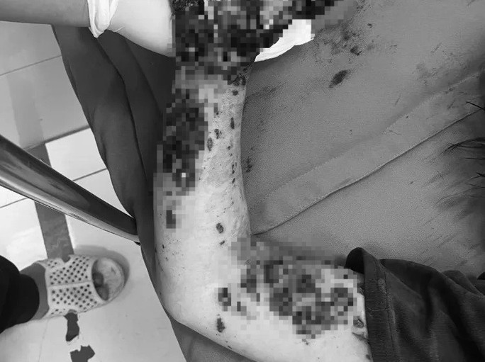 Cánh tay của bệnh nhân bị dập nát. Ảnh: Bệnh viện cung cấp