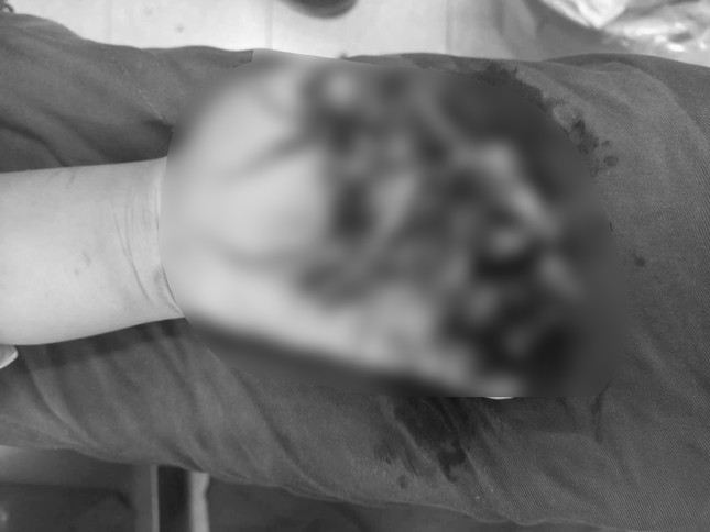 Bàn tay nạn nhân bị thương nghiêm trọng sau vụ nổ.