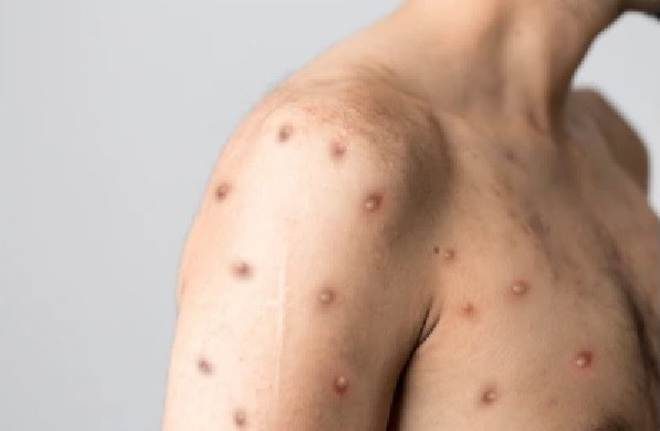 Mụn nước trên thân một người mắc đậu mùa khỉ. Ảnh: SHUTTERSTOCK