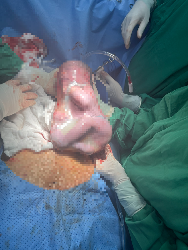 Bé gái sinh trong "bọc điều". ẢNH BỆNH VIỆN CUNG CẤP Bé gái sinh trong "bọc điều". ẢNH BỆNH VIỆN CUNG CẤP