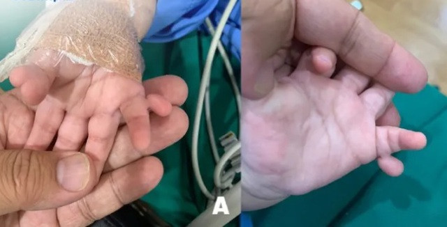 Bé gái có 24 ngón tay chân, dư ngón dính ngón được phẫu thuật tạo hình - Ảnh 1. Bàn tay của bé bị thừa ngón, dính ngón. Ảnh: BSCC