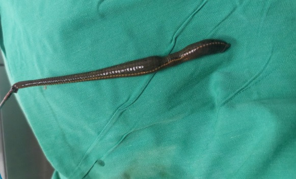 Con đĩa được gắp ra khỏi bàng quang bệnh nhân