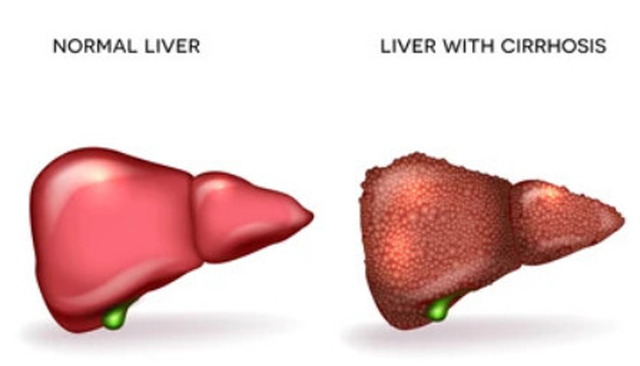 Giai đoạn cuối của gan nhiễm mỡ là xơ gan. Ảnh: SHUTTERSTOCK