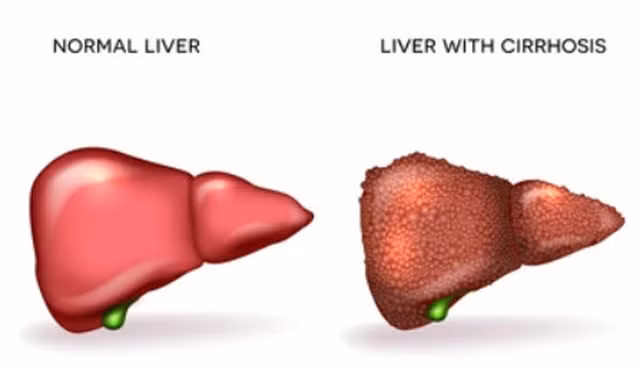 Giai đoạn cuối của gan nhiễm mỡ là xơ gan. Ảnh: SHUTTERSTOCK