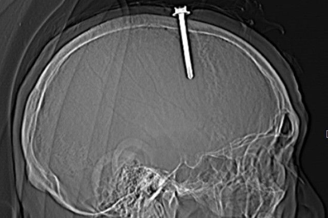 Hình ảnh cây đinh đâm xuyên vào hộp sọ bệnh nhân. Ảnh: BVĐK Thanh Hóa Hình ảnh cây đinh đâm xuyên vào hộp sọ bệnh nhân. Ảnh: BVĐK Thanh Hóa