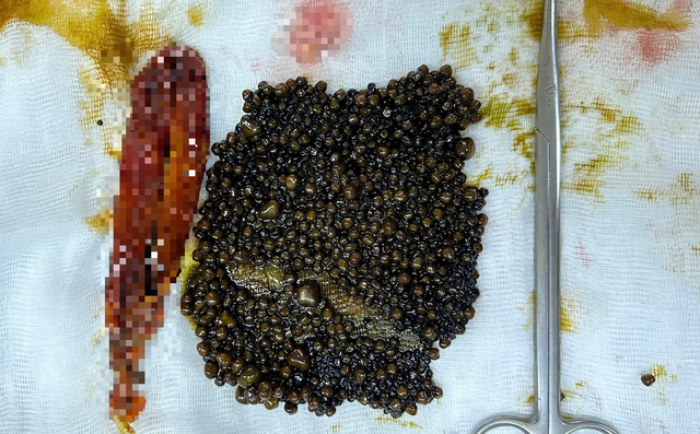 Hơn 1.100 viên sỏi túi mật được bóc tách ra khỏi túi mật bệnh nhân. Ảnh: Đình Tuyển