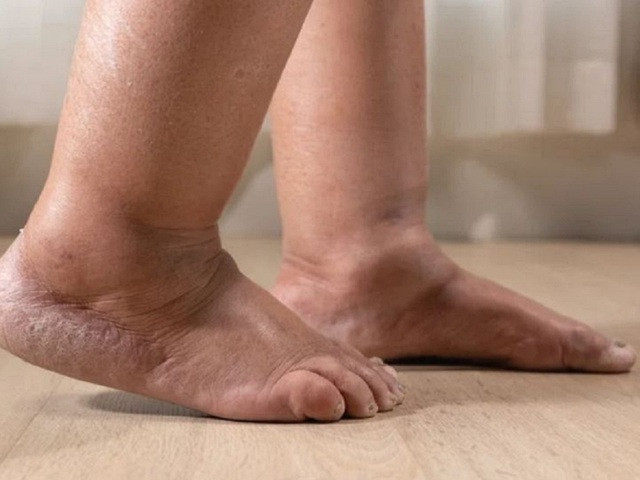 3 dấu hiệu kèm theo sưng chân cần đến bệnh viện kiểm tra ngay - Ảnh 1. Bàn chân sưng kèm theo đau nhức thì cần đến bác sĩ kiểm tra ngay. Ảnh: SHUTTERSTOCK