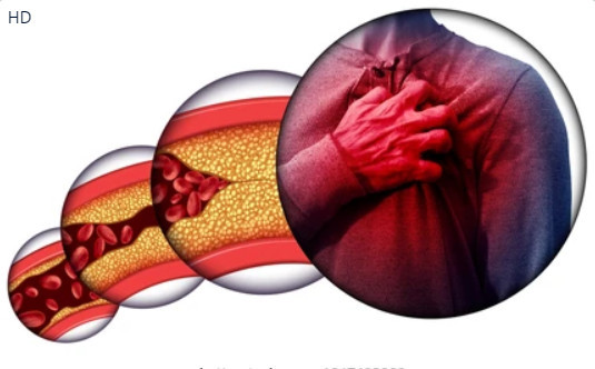 Ăn chay có thể cắt giảm đáng kể lượng cholesterol và chất béo trong máu, từ đó giảm nguy cơ đau tim, đột quỵ. Ảnh: Shutterstock