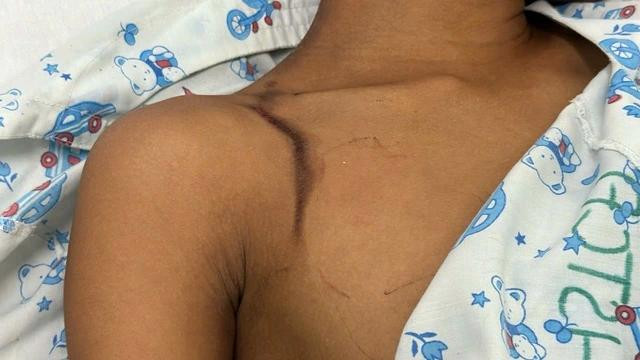 Vết sét đánh còn trên vai của bệnh nhân. Ảnh LÊ LÂM