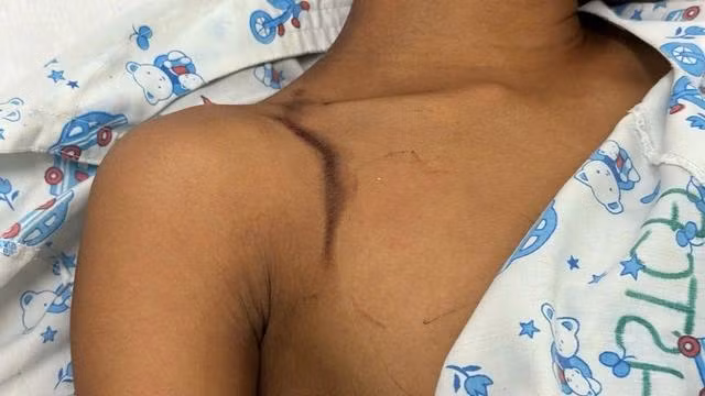 Vết sét đánh còn trên vai của bệnh nhân. Ảnh LÊ LÂM