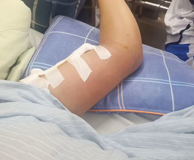 Bệnh nhân Whitmore bị sưng đau, áp-xe tay trái, ổ vi khuẩn vào xương.