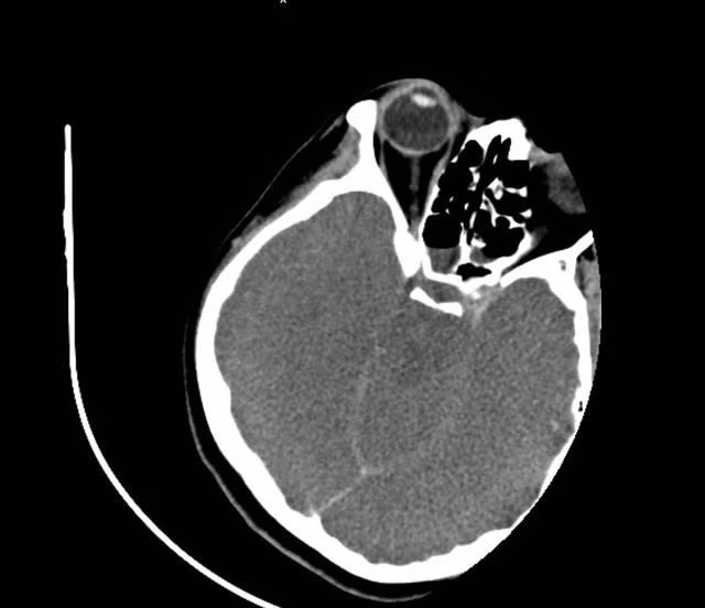 Phim chụp não nữ bệnh nhân bị tổn thương, phù nề sau khi uống nhầm nước đun từ rễ cây lá ngón. TRUNG TÂM CHỐNG ĐỘC
