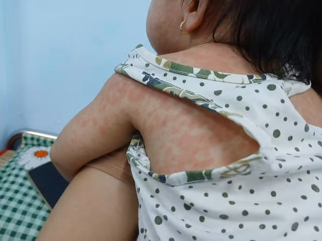 Trẻ mắc sởi được điều trị tại Bệnh viện Nhi đồng 1 (TP HCM)