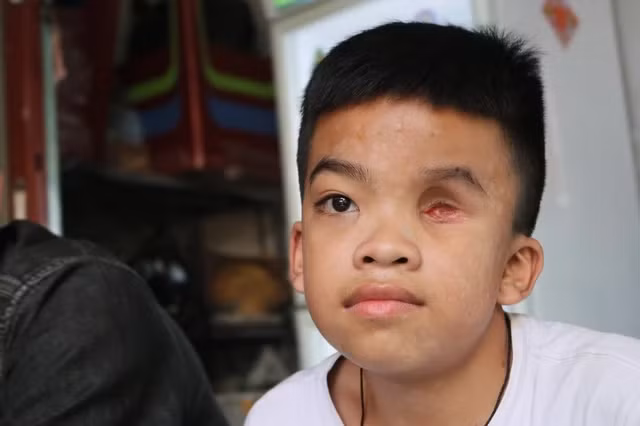 Bé Khang điều trị bệnh ung thư mắt được 11 năm. Ảnh: UYỂN NHI