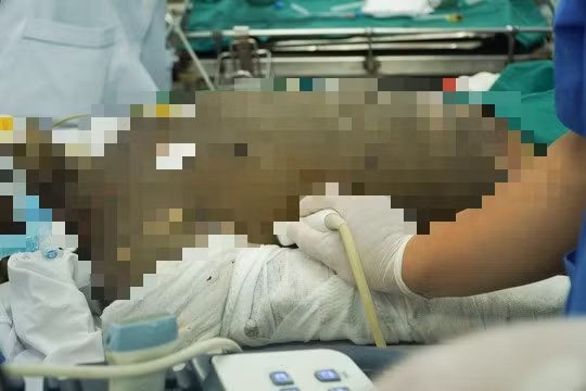 Nạn nhân bỏng 90% vừa chuyển lên Bệnh viện Chợ Rẫy