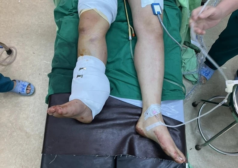 Do vết thương dập nát nên để khâu nối được vết thương, các bác sĩ đã phải cắt ngắn xương, mạch máu và gân mới có thể khâu nối được bàn chân cho bệnh nhân.