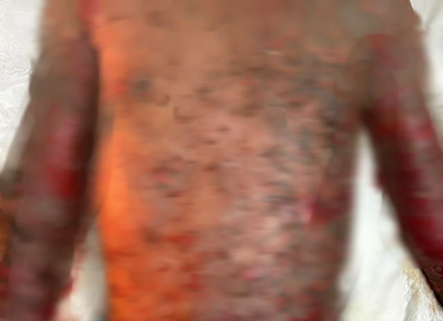 Tổn thương trợt hoại tử ghi nhận ở nam bệnh nhân pemphigus á u