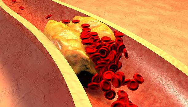 Đối với người bị cholesterol cao, việc điều chỉnh chế độ ăn uống có thể giúp kiểm soát tình trạng bệnh. Ảnh: SHUTTERSTOCK