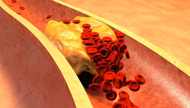 Đối với người bị cholesterol cao, việc điều chỉnh chế độ ăn uống có thể giúp kiểm soát tình trạng bệnh. Ảnh: SHUTTERSTOCK