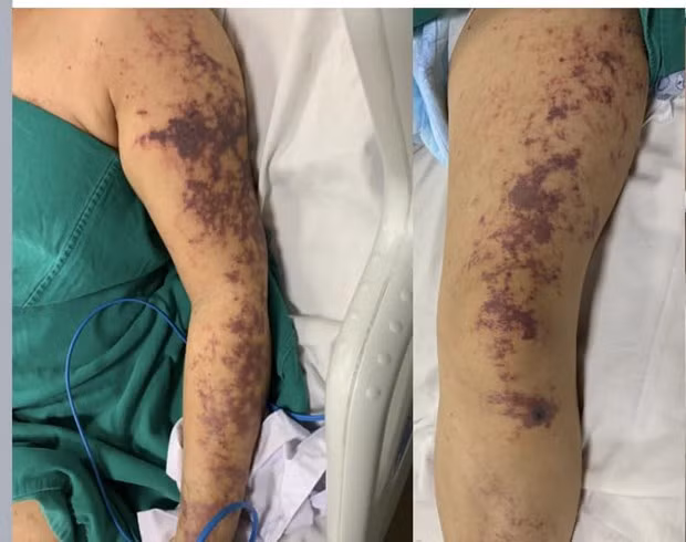 Hình ảnh cơ thể bệnh nhân mắc liên cầu lợn. (Ảnh: PV/Vietnam+)