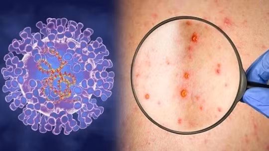 Một trong những dấu hiệu của bệnh đậu mùa khỉ là tổn thương trên da.