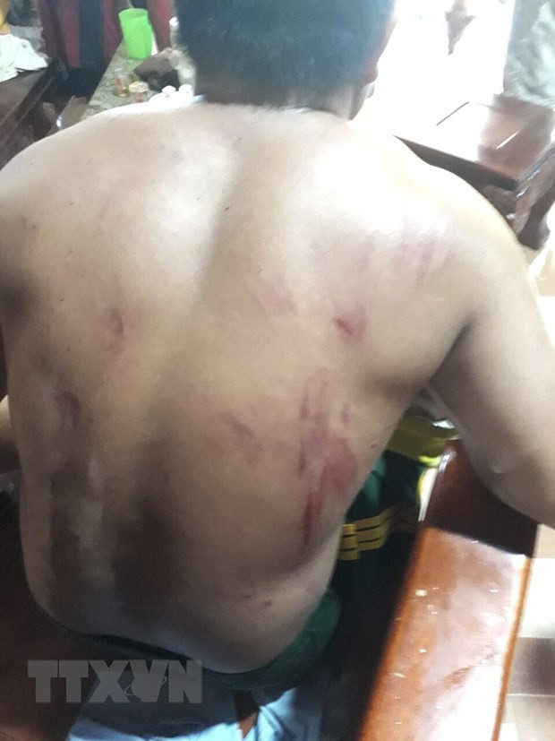 Anh Lê Văn Liêm bị voi rừng tấn công khiến chấn thương nặng, gãy chân, trầy xước cơ thể. (Ảnh: TTXVN phát)