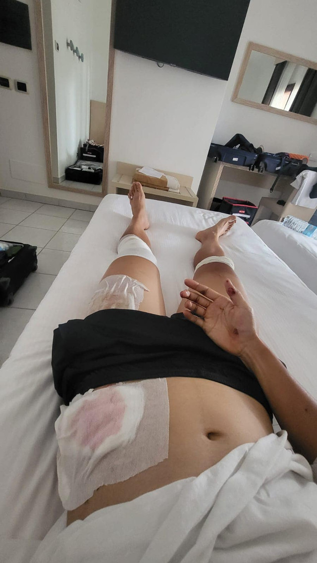 Nguyễn Thị Thật gặp tai nạn phải khâu nhiều mũi, bỏ cuộc ở Giro d’Italia Donne 2023 - Ảnh 2. Nguyễn Thị Thật bị đa chấn thương khi gặp tai nạn trong lúc đổ đèo chặng 8. Ảnh: NVCC