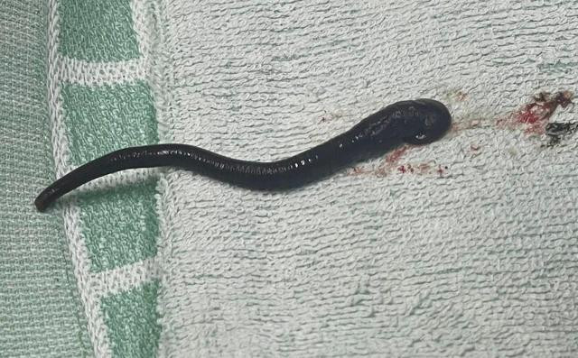 Các bác sĩ đã gắp con vắt ra khoang mũi của bệnh nhân. Ảnh: TRANG ANH Các bác sĩ đã gắp con vắt ra khoang mũi của bệnh nhân. Ảnh: TRANG ANH