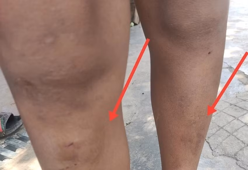 Một cháu nhỏ bị đánh sưng chân. Ảnh: N.D