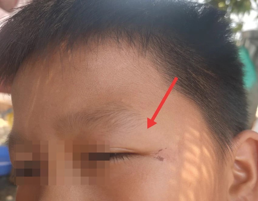 Một trong năm cháu nhỏ bị đánh. Ảnh: N.D Một trong năm cháu nhỏ bị đánh. Ảnh: N.D