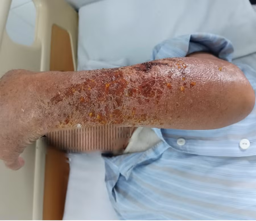 Phần cánh tay của bệnh nhân bị nhiễm trùng. (Ảnh: BVCC)