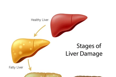 Chớ chủ quan khi bị gan nhiễm mỡ!