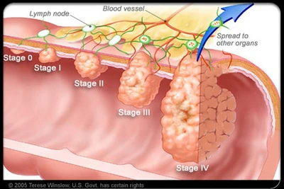 Những dấu hiệu báo động ung thư đại tràng đã di căn