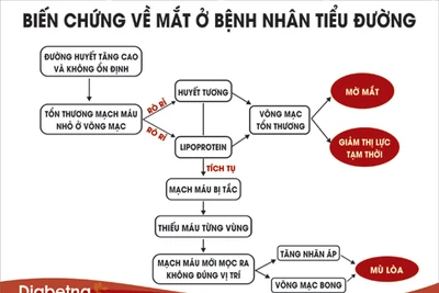 4 cách giảm nguy cơ mù lòa ở bệnh nhân tiểu đường