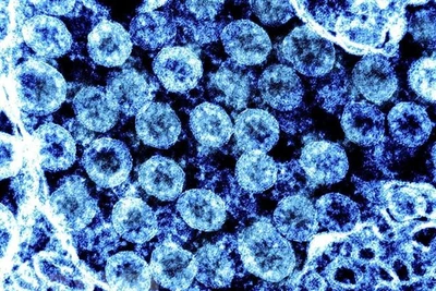 Virus gây bệnh Covid-19 có thể gây viêm não tương tự bệnh Parkinson