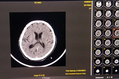 Cứu sống ca bệnh đột quỵ thập tử nhất sinh trên bàn mổ