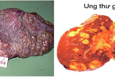 Nguyên nhân khiến người Việt mắc và chết vì ung thư gan cao thứ 4TG