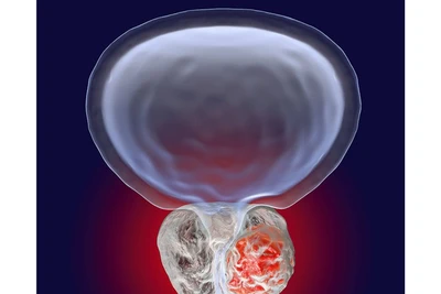 Liệu pháp hormone điều trị ung thư tuyến tiền liệt có thể tăng nguy cơ tim mạch