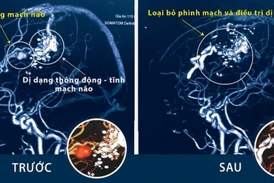 Đột ngột đau đầu dữ dội, coi chừng đột quỵ, xuất huyết màng não