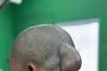 Bệnh viện Đại học Y Dược-Hoàng Anh Gia Lai cắt bỏ thành công khối u lạ 30 năm treo trên đầu bệnh nhân