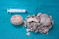 Bệnh viện Hùng Vương Gia Lai phẫu thuật lấy viên sỏi bàng quang “khổng lồ” 