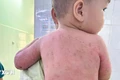Bé trai 2 tuổi bị bỏng 60% được cứu sống nhờ ghép da từ mẹ