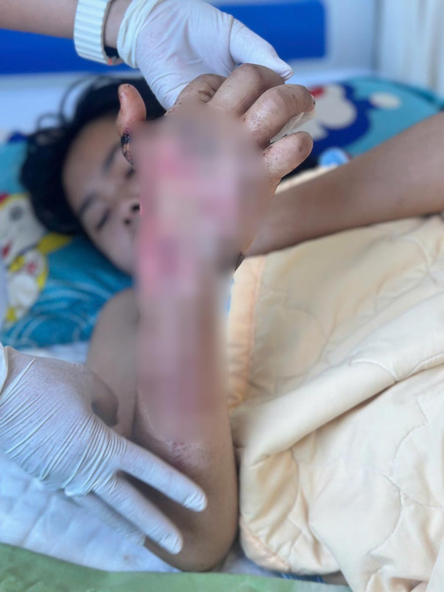 Các ngón tay bàn tay phải của em Q. đã có thể cử động sau ca phẫu thuật lần 2. Ảnh: ĐVCC f5b31c36-4536-44a6-b93d-1a602217e3bc.jpg