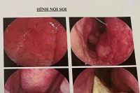 Gia Lai: Một thanh niên có răng mọc ở… hốc mũi