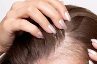 Chế độ ăn uống của 61.000 người hé lộ nguyên nhân gây rụng tóc