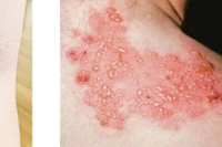 Báo động bệnh viêm não hiếm gặp tăng bất thường