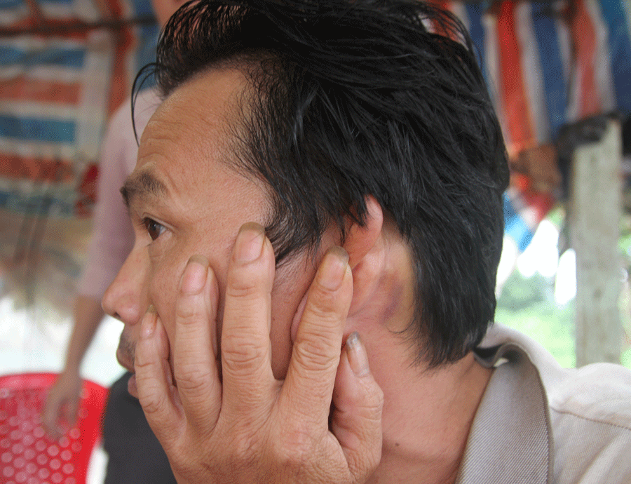 Anh Võ Ánh bị Sơn dùng báng súng đánh vào sau gáy. Ảnh: V.N