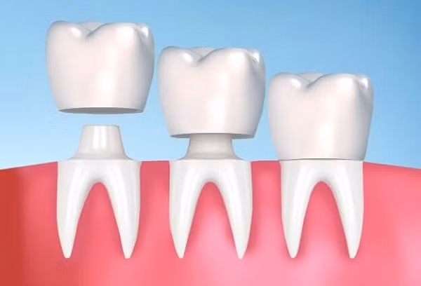 Bọc răng sứ được xem là giải pháp nhanh chóng để điều chỉnh răng hô nhẹ Bọc răng sứ được xem là giải pháp nhanh chóng để điều chỉnh răng hô nhẹ